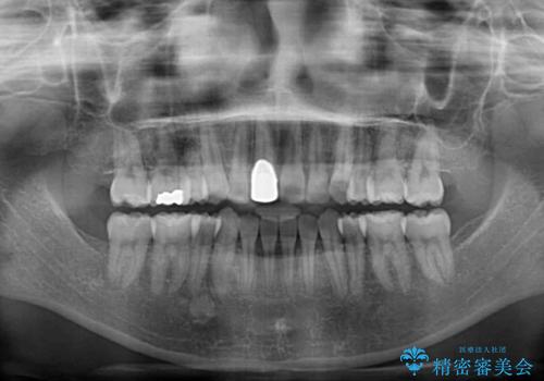 八重歯とクロスバイト 目立たないワイヤー装置での抜歯矯正の治療後