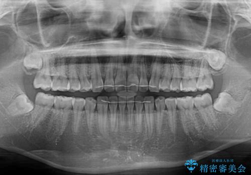 すきっ歯とオープンバイト インビザライン・ライトで改善の治療後
