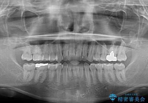 前歯のデコボコを治したい　ワイヤー装置でお手軽に矯正治療の治療後