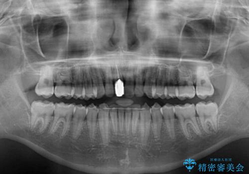 前歯のデコボコを治したい インビザライン矯正治療の治療後