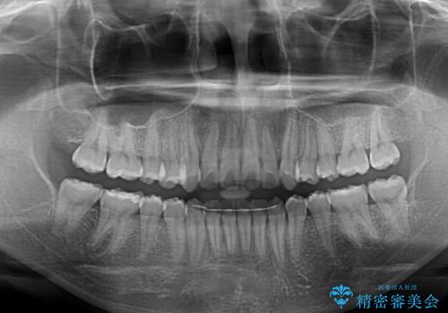 【モニター】八重歯と前歯のクロスバイト ワイヤーを併用しインビザラインで矯正治療の治療後