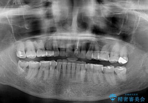 矯正治療の後戻り インビザライン・ライトでの再矯正の治療後