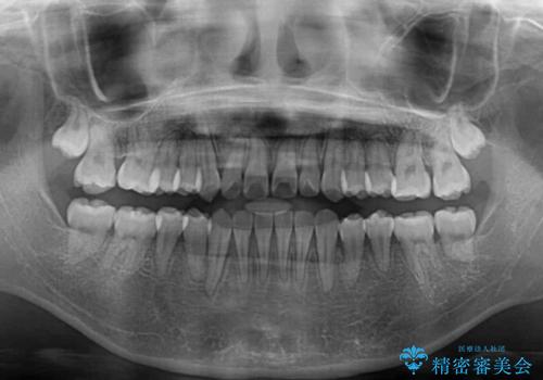 急速拡大装置 狭い上顎骨を拡大してワイヤー装置で短期間治療の治療後