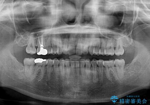 転勤予定がある インビザラインによる矯正治療の治療後