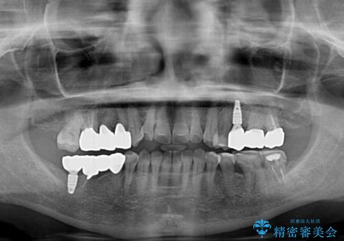 治療後に歯茎から出血 インプラントとオールセラミッククラウンの補綴治療の治療後