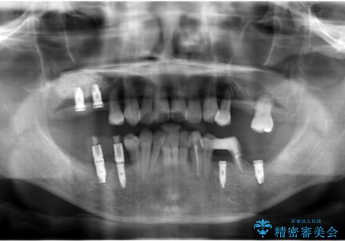 インプラント治療を併用した全顎歯周病治療の治療中