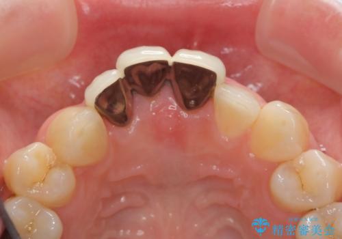 [ セラミック治療 ]前歯を審美的に治して欲しいの治療前