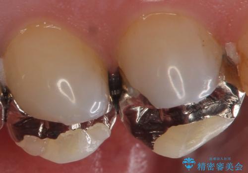 外から見える銀歯 セラミックでのやり替えの治療前