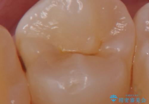 奥歯の虫歯 セラミックインレーによる治療の症例 治療前