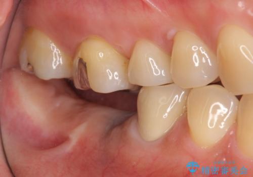 臼歯部インプラント治療の治療前