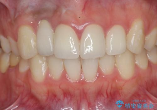 前歯の虫歯 オールセラミック治療の治療後