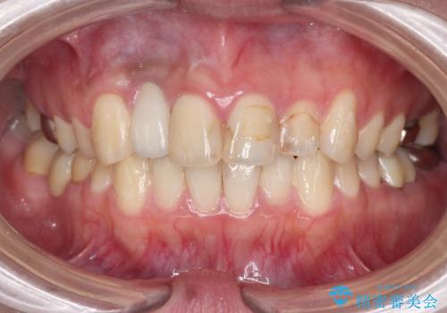 前歯の虫歯　オールセラミック治療の治療前