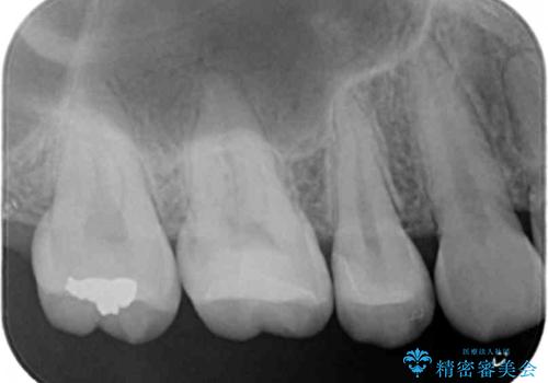 たまにしみる奥歯 セラミックインレーでの修復の治療後