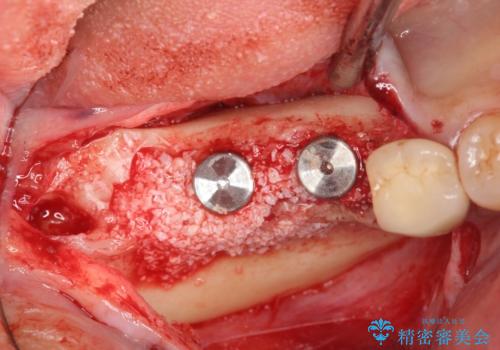 臼歯部インプラント治療の治療中