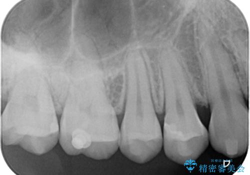 【セラミックインレー】歯と歯の間の虫歯治療の治療後