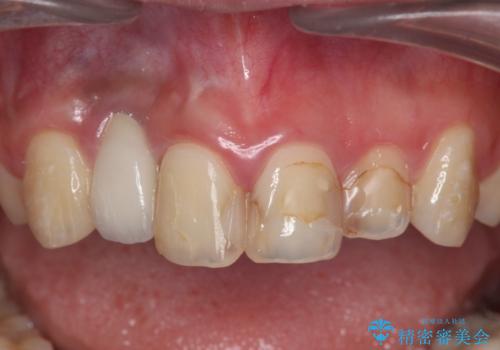 前歯の虫歯 オールセラミック治療の治療前