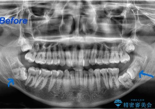 矯正前の親知らず抜歯(埋伏)の治療前