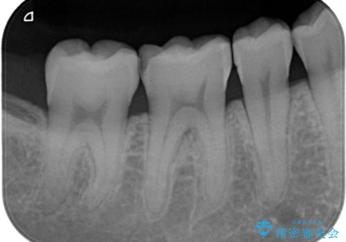 矯正終了後、詰め物を綺麗にしたい。セラミック治療の治療前
