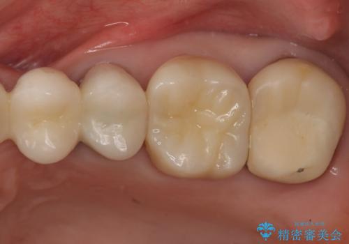 時々しみる奥歯 適合の悪いインレーからクラウンへのやり替えの治療後