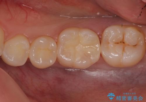 奥歯の虫歯 セラミックインレーによる治療の治療後