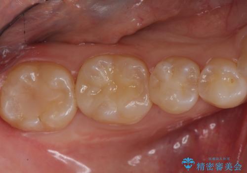 隠れているむし歯 セラミックインレーによる治療の症例 治療後