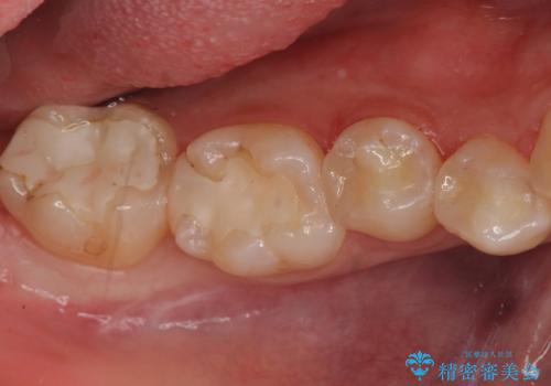 検査で見つかった虫歯　セラミックインレーでの修復の症例 治療後