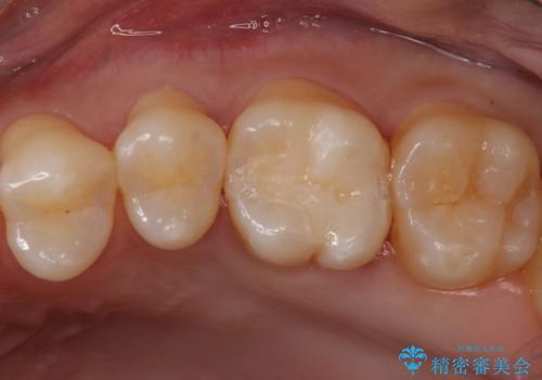 奥歯に隠れた虫歯　セラミックインレーでの修復の治療後