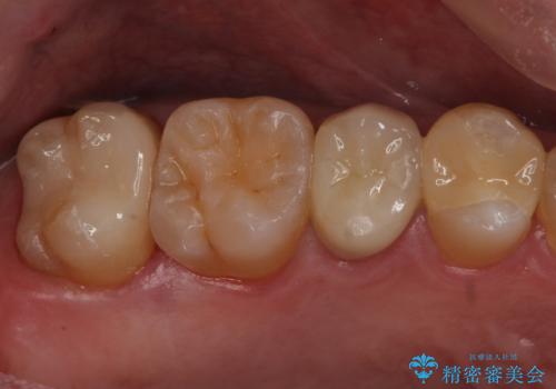 放置していた虫歯 セラミックインレーによる治療の症例 治療後