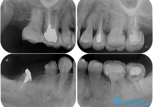 治療後に歯茎から出血 インプラントとオールセラミッククラウンの補綴治療の治療前