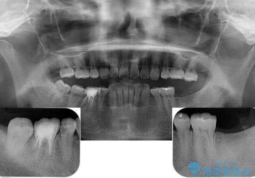 部分矯正を併用した奥歯のインプラント治療の治療前