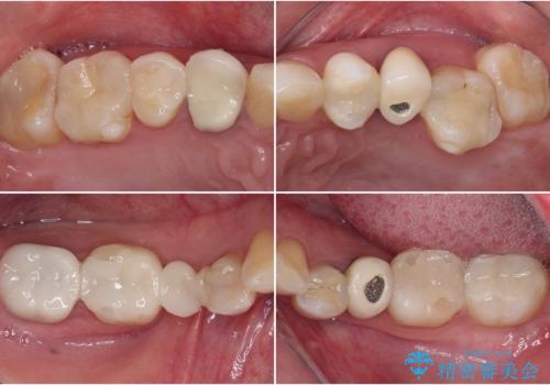 金属の見えてしまったクラウン セラミッククラウンで自然にの治療前