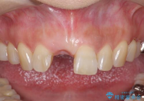 骨造成を伴う前歯のインプラント治療の症例 治療前