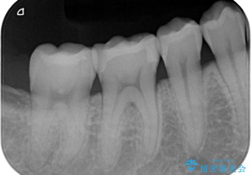 矯正終了後、詰め物を綺麗にしたい。セラミック治療の治療後