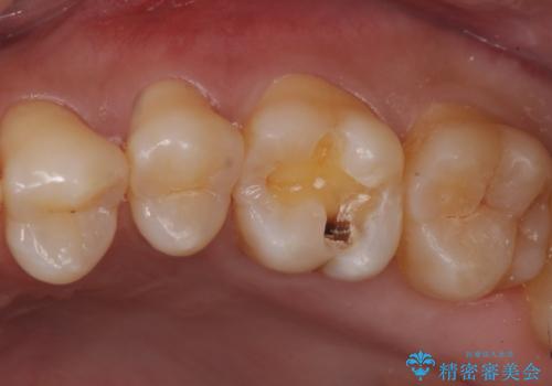 奥歯に隠れた虫歯　セラミックインレーでの修復の治療中