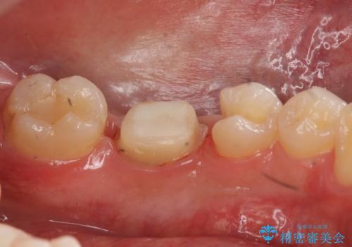 銀歯のやり替え　セラミックで白い歯にの治療中