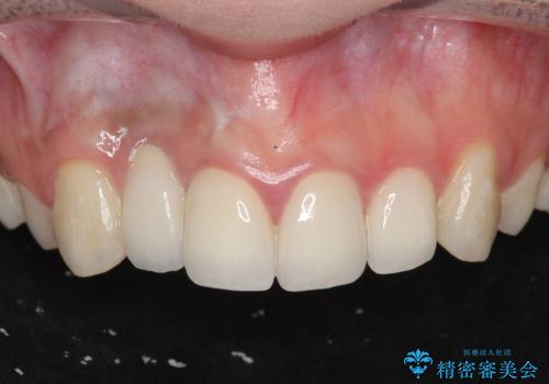 前歯の虫歯　オールセラミック治療の症例 治療後