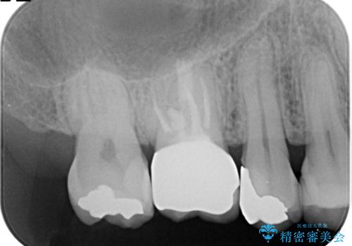 【MTAを用いた生活歯髄療法】神経に到達する深い虫歯の治療前