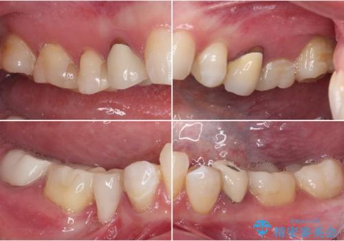 金属の見えてしまったクラウン セラミッククラウンで自然にの治療前