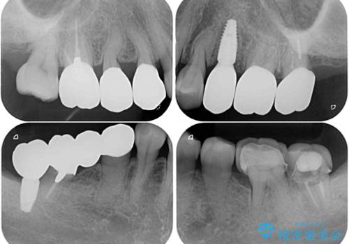 治療後に歯茎から出血 インプラントとオールセラミッククラウンの補綴治療の治療後