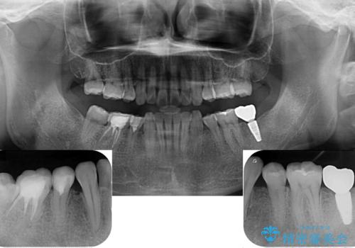 部分矯正を併用した奥歯のインプラント治療の治療後