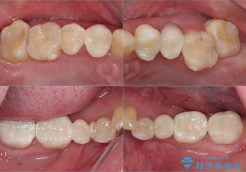 金属の見えてしまったクラウン セラミッククラウンで自然にの治療後