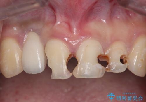 前歯の虫歯　オールセラミック治療の治療中