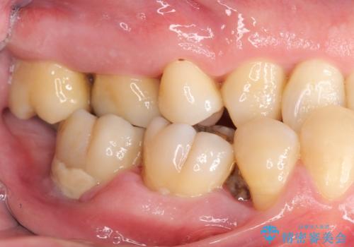 インプラント治療を併用した全顎歯周病治療の治療前