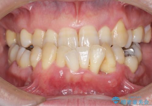インプラント治療を併用した全顎歯周病治療の症例 治療前