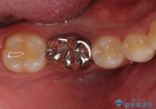 銀歯のやり替え セラミックで白い歯に