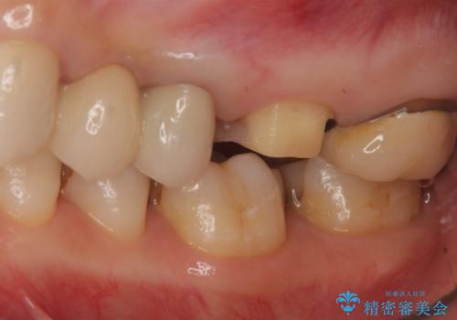時々しみる奥歯 適合の悪いインレーからクラウンへのやり替えの治療中