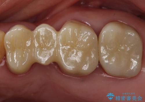 銀歯を白くしたい　セラミックブリッジでの治療の症例 治療後