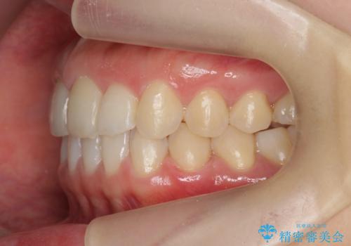 前歯のガタつきをきれいに　マウスピース矯正治療の治療後