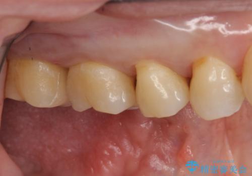 奥歯の虫歯 セラミックインレーによる治療の治療後