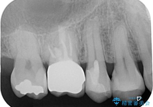 【MTAを用いた生活歯髄療法】神経に到達する深い虫歯の治療後